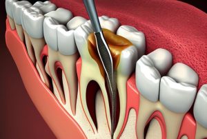 Cavity Formation Near Pasadena | cheap dentist near Pasadena