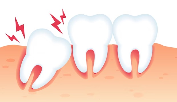 Affordable Wisdom Teeth Extraction | cheap dentist near Pasadena