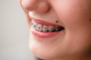 Dental Brackets In Pasadena