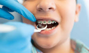 Best Orthodontist for Kids Near Westwood